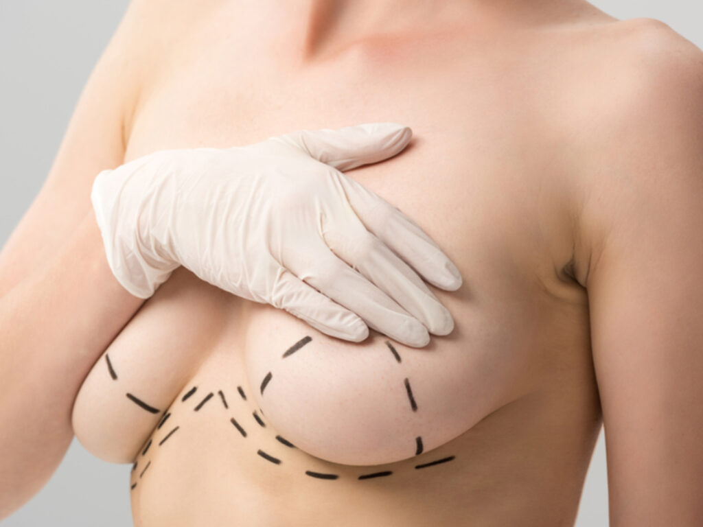 Breast Lift