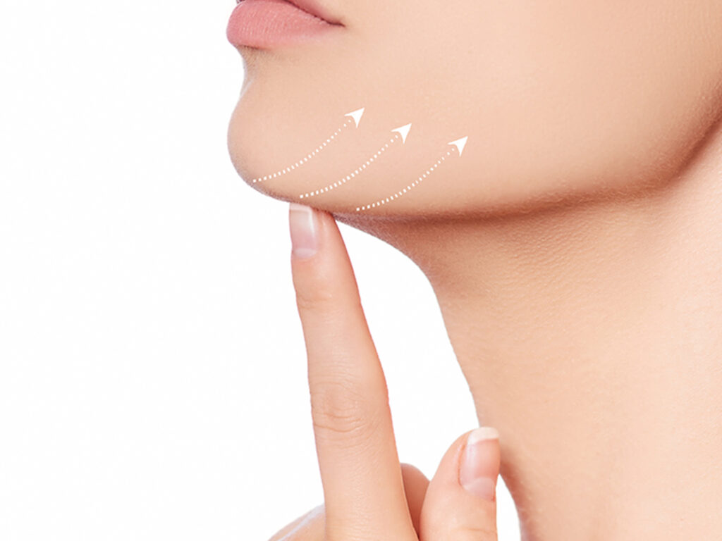 Chin Liposuction